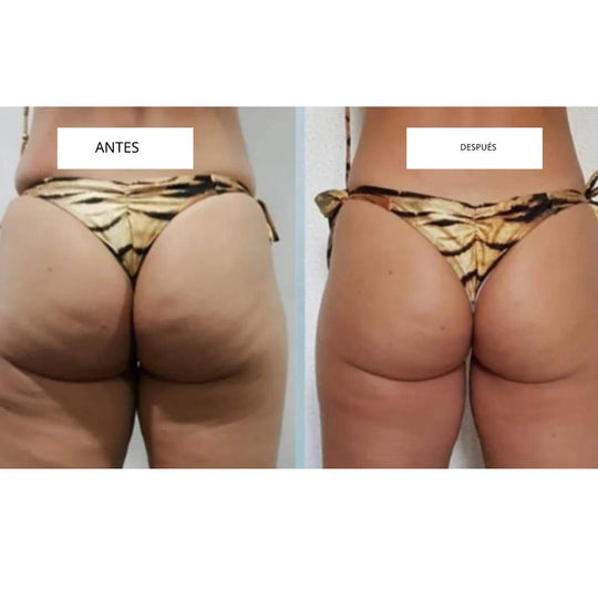 CelluLift™ | Tonifica tu piel con el masajeador de vacío anticelulitis
