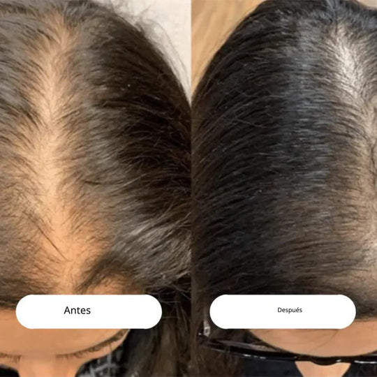 RadiantRoots™ | Descubre un cabello más abundante con el cepillo LED para crecimiento capilar