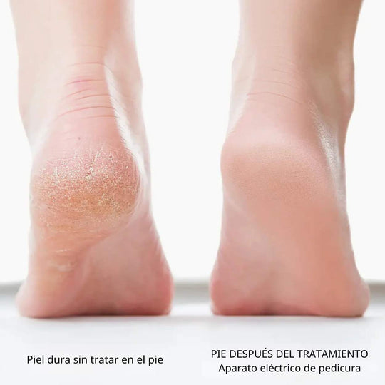 Dispositivo de pedicura eléctrico™ | ¡Piel suave al instante!