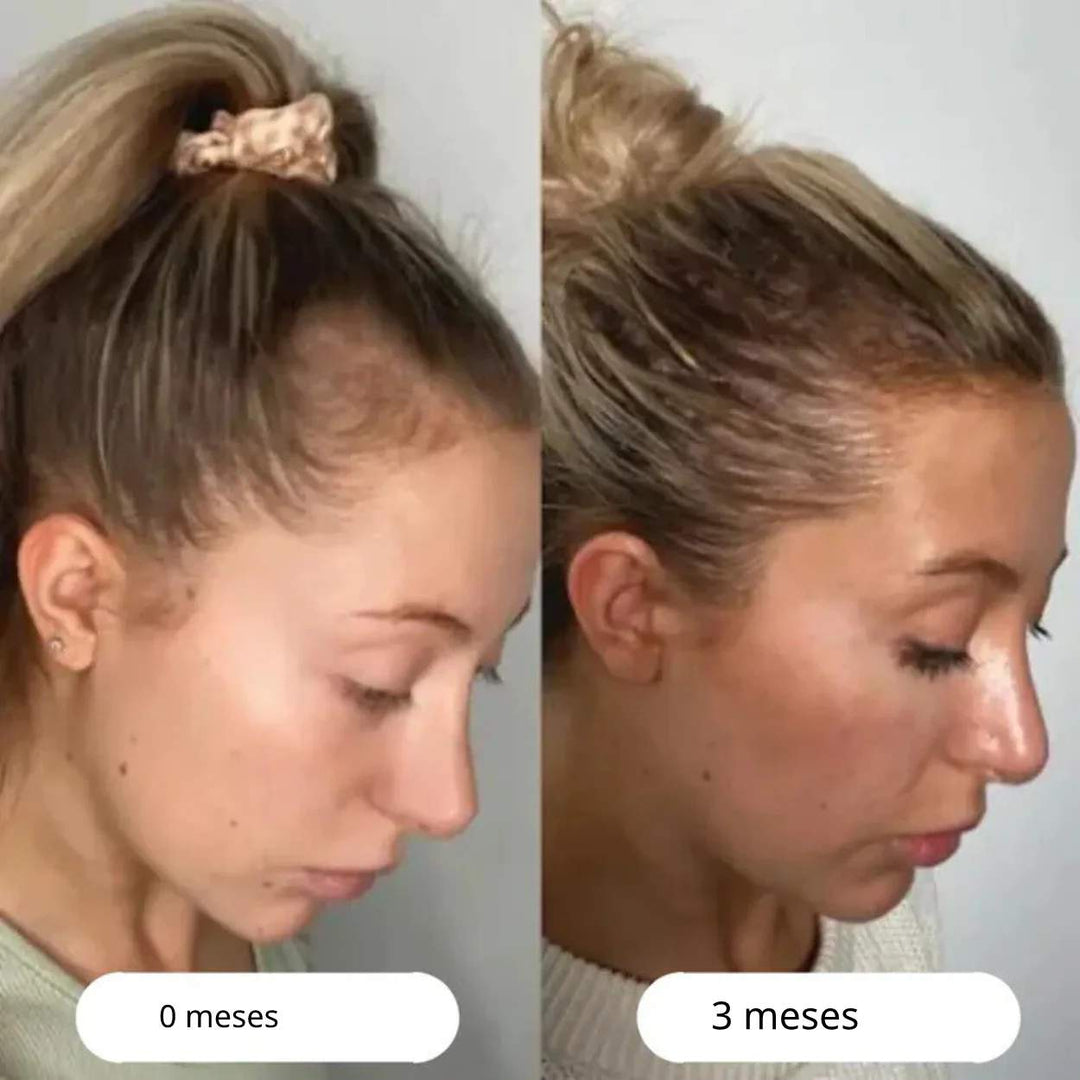 RadiantRoots™ | Descubre un cabello más abundante con el cepillo LED para crecimiento capilar