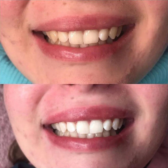 SmileKit™ | Dientes blancos, encías saludables y aliento fresco