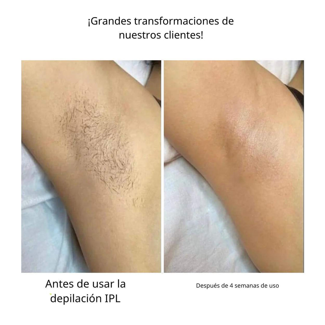 GlowFree™ | Piel sin vello con facilidad con el depilador láser IP
