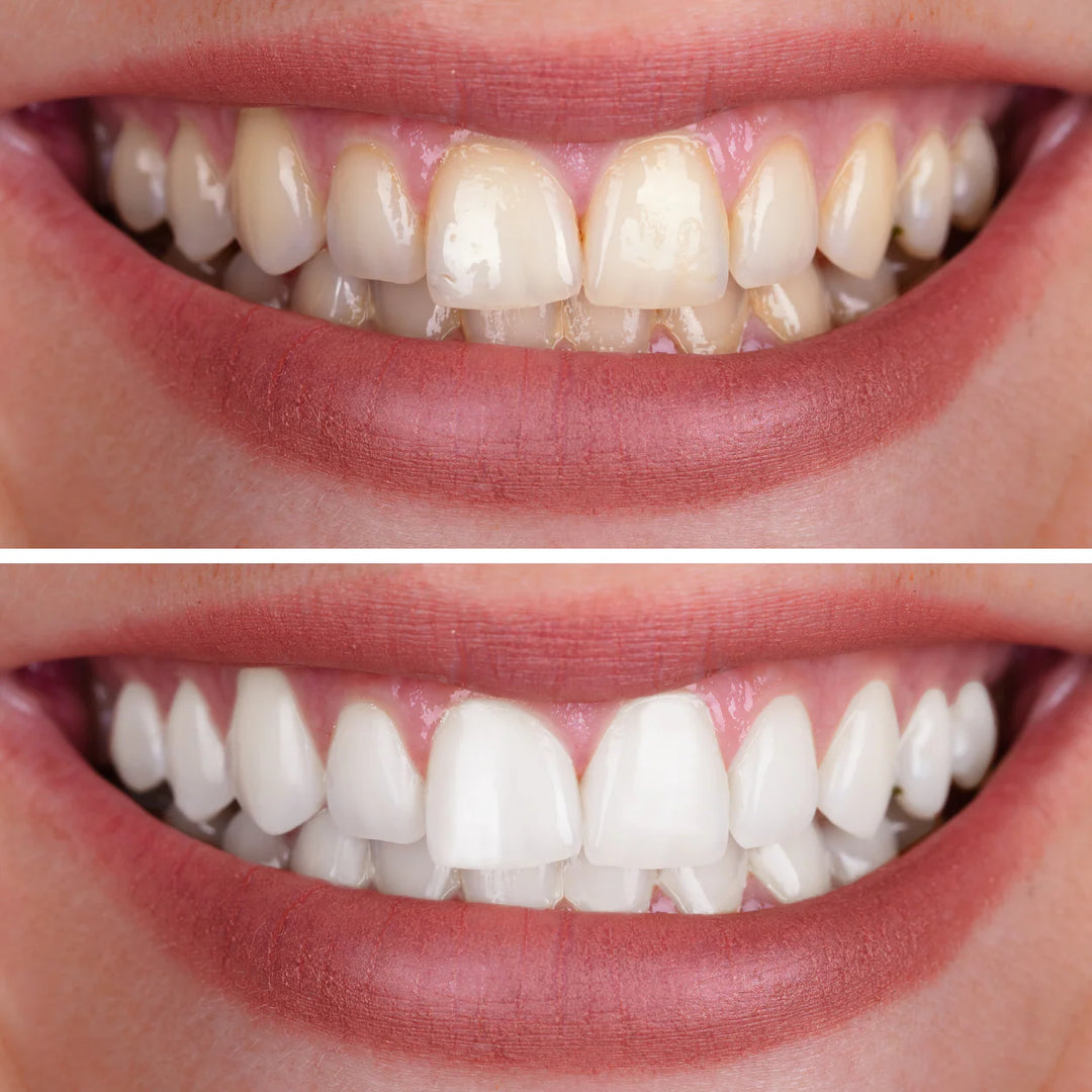 SmileKit™ | Dientes blancos, encías saludables y aliento fresco