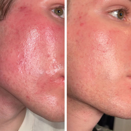 Mangalo Mascarilla Facial™ | Mascarilla Infrarroja Flexible!