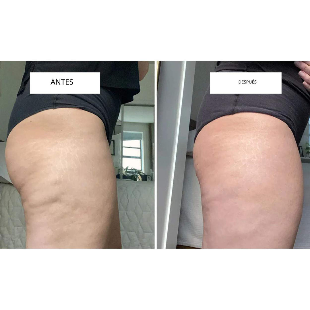 CelluLift™ | Tonifica tu piel con el masajeador de vacío anticelulitis