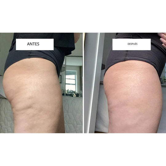 CelluLift™ | Tonifica tu piel con el masajeador de vacío anticelulitis
